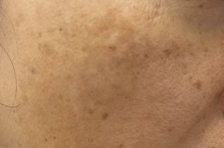 腋下皮肤暗沉黑斑的成因及科学预防
