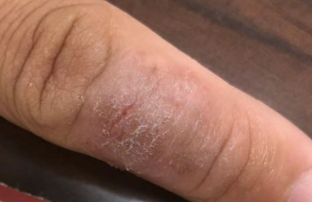 得了手足癣，鸡蛋还能安心吃吗？答案在这里！