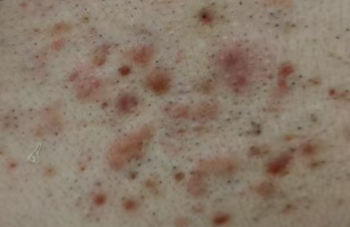 头皮长了毛囊炎疙瘩用什么洗发水？日常科普