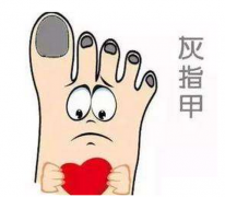 佛山灰指甲的发病诱因主要是什么